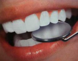 Ошибки при отбеливании зубов