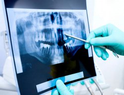 Побочные явления и осложнения при зубной имплантации
