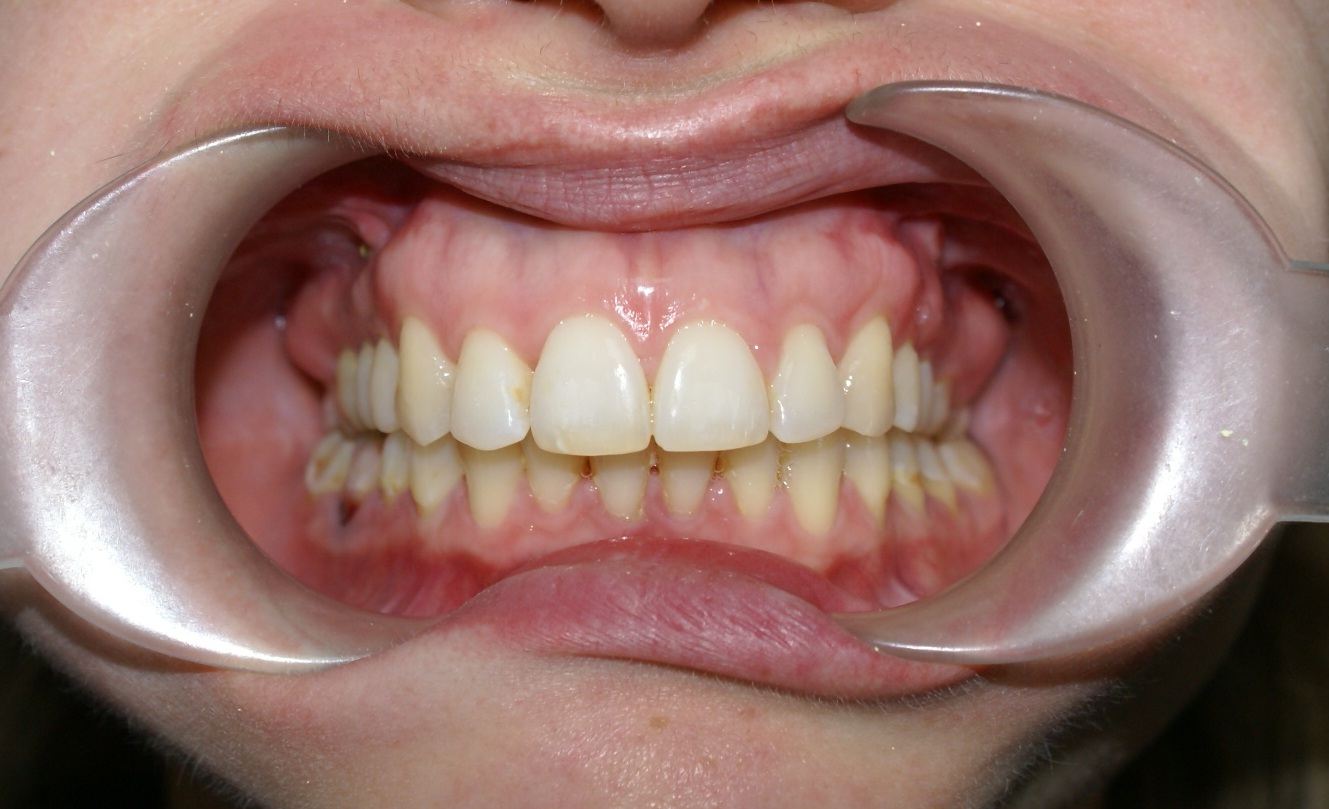 Исправление прикуса в Москве