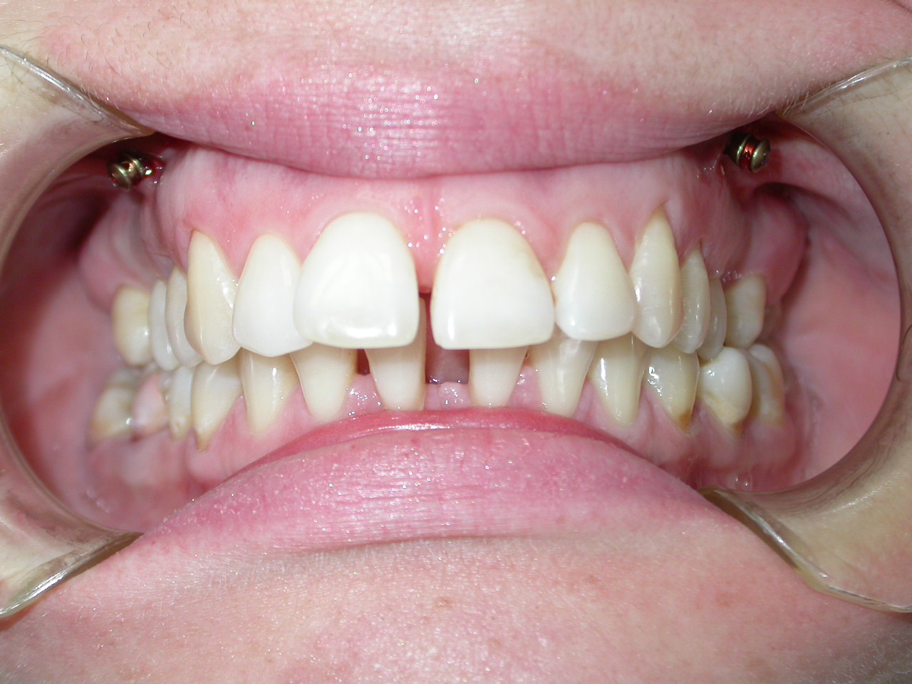 Исправление прикуса в Москве